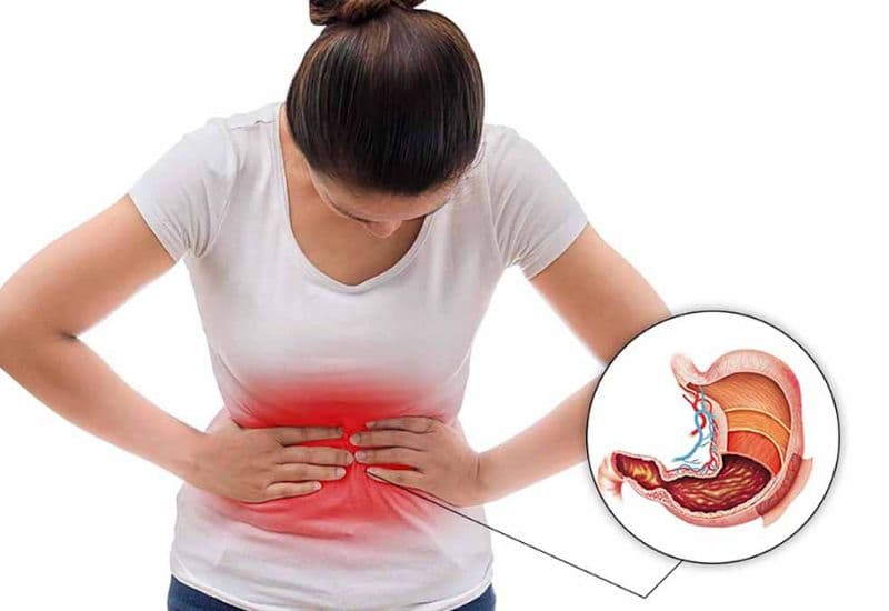 trào ngược dạ dày kèm đầy bụng - Image 5