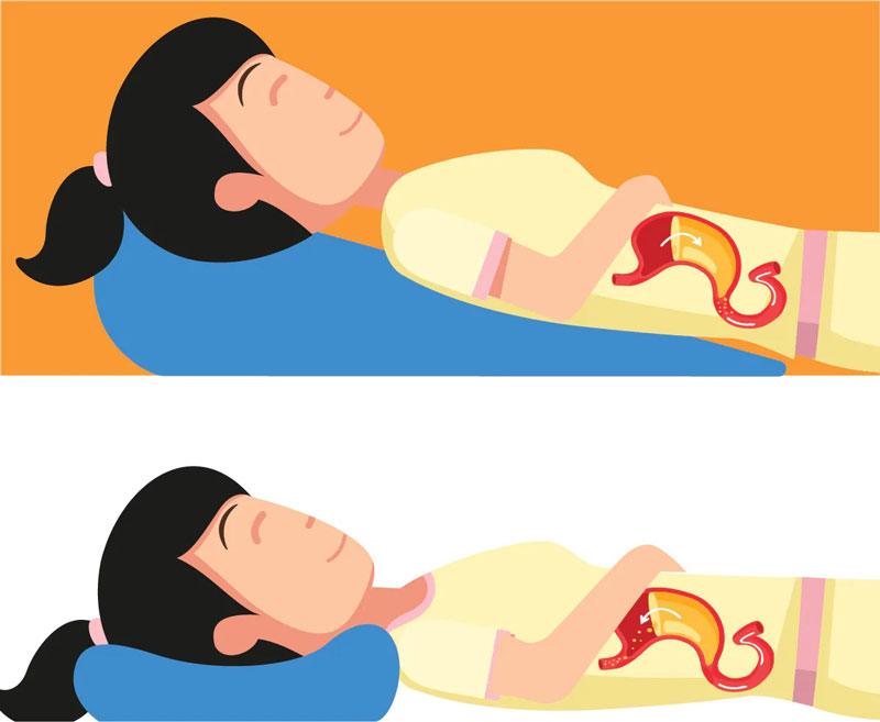 trào ngược dạ dày khi nằm - Image 2