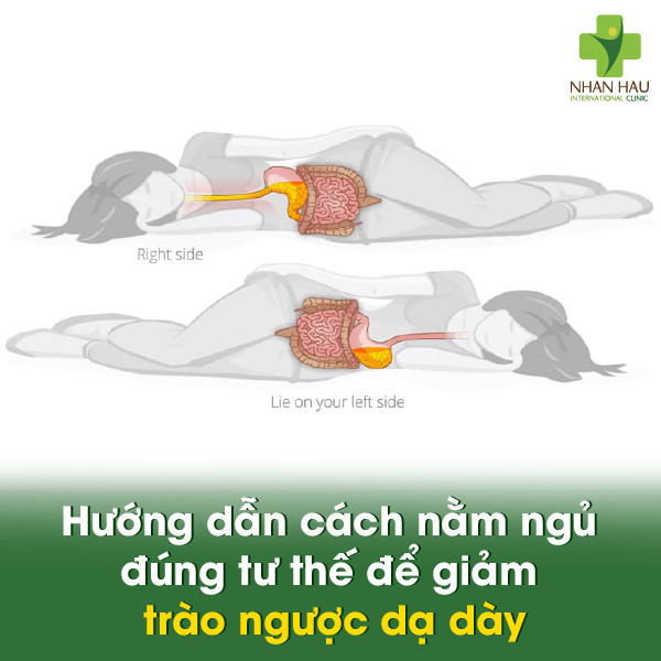 trào ngược dạ dày khi nằm - Image 3