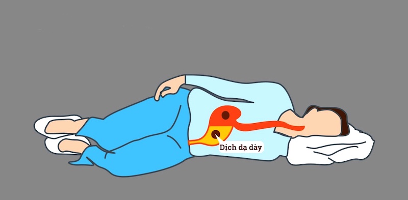 trào ngược dạ dày khi nằm - Image 4
