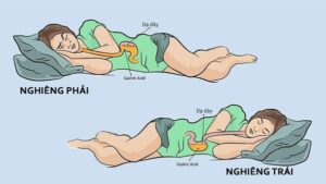 trào ngược dạ dày khi ngủ