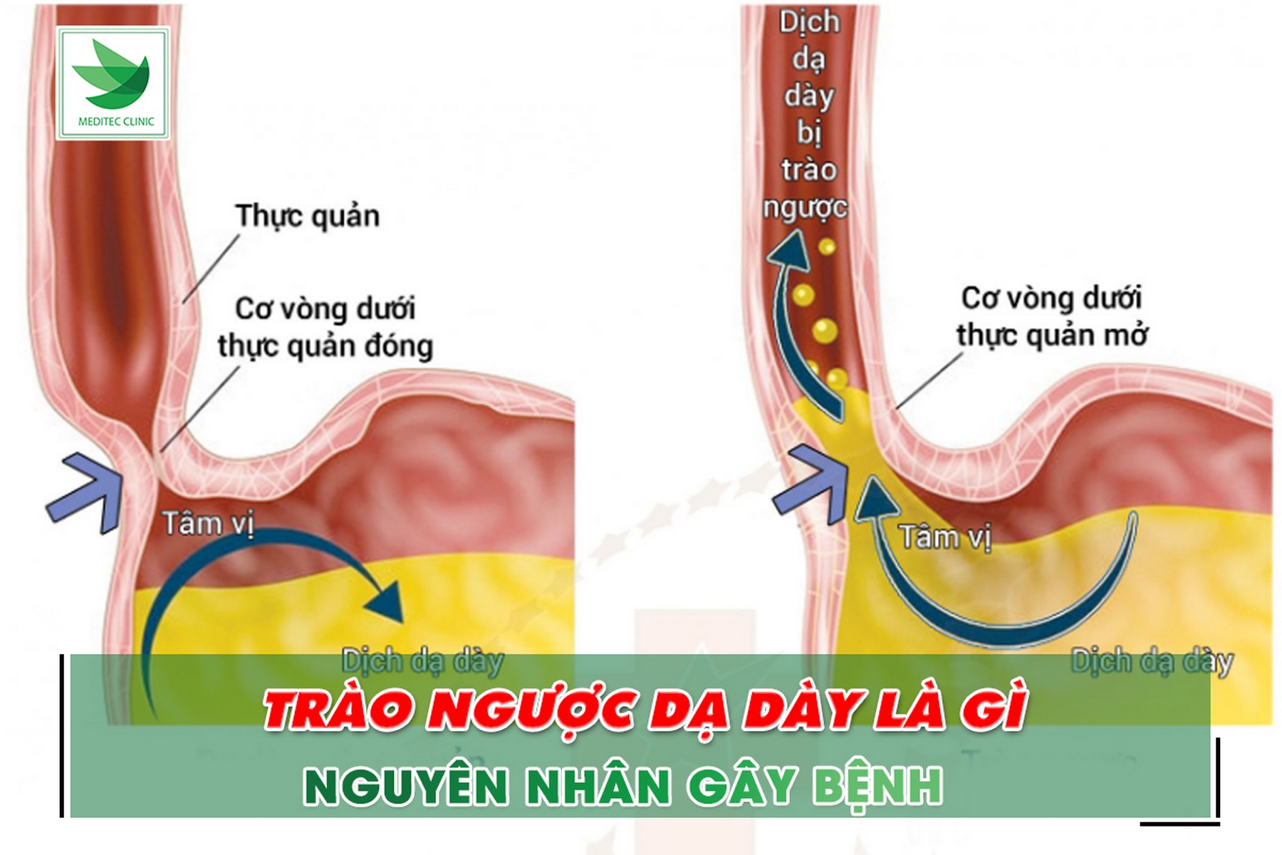 trào ngược dạ dày là gì - Image 3