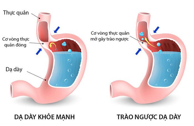 trào ngược dạ dày là gì