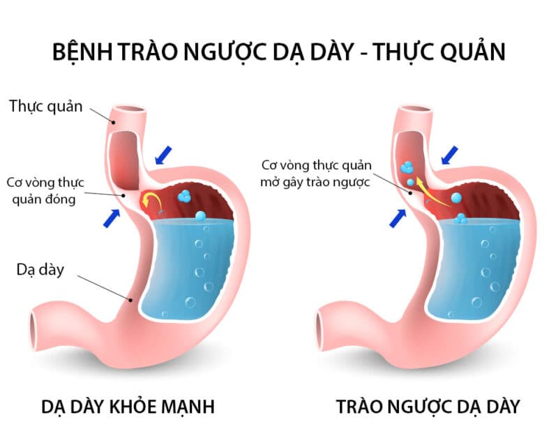 trào ngược dạ dày ở người lớn tuổi - Image 5