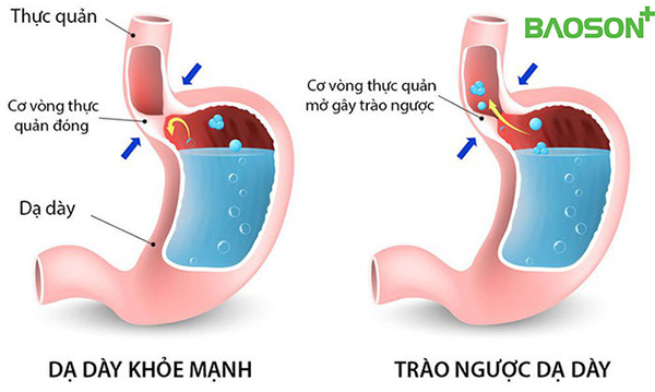 trào ngược dạ dày sau khi ăn tối - Image 4