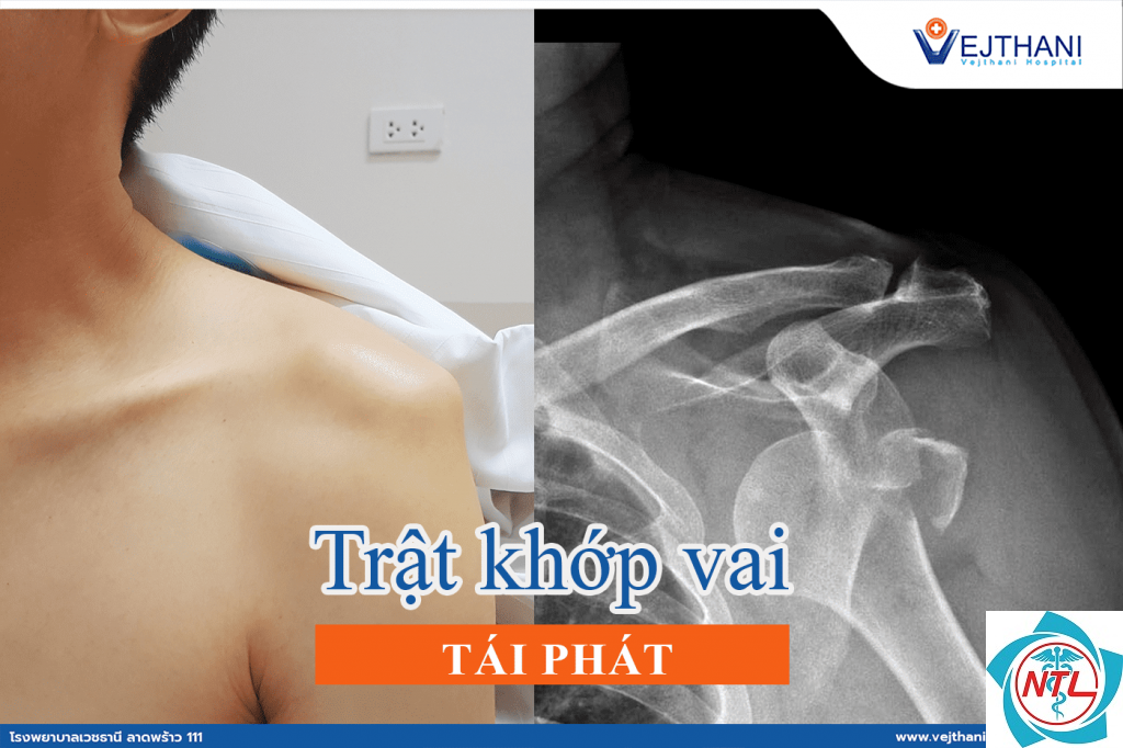 trật khớp vai - Image 3