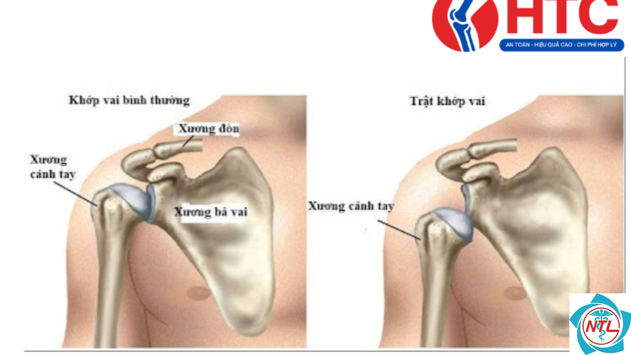 trật khớp vai - Image 4