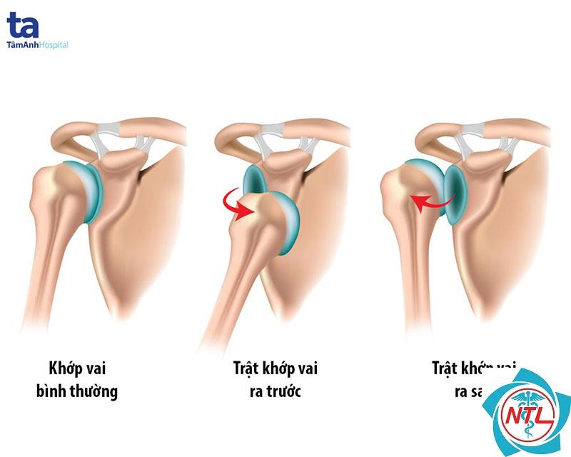 trật khớp vai