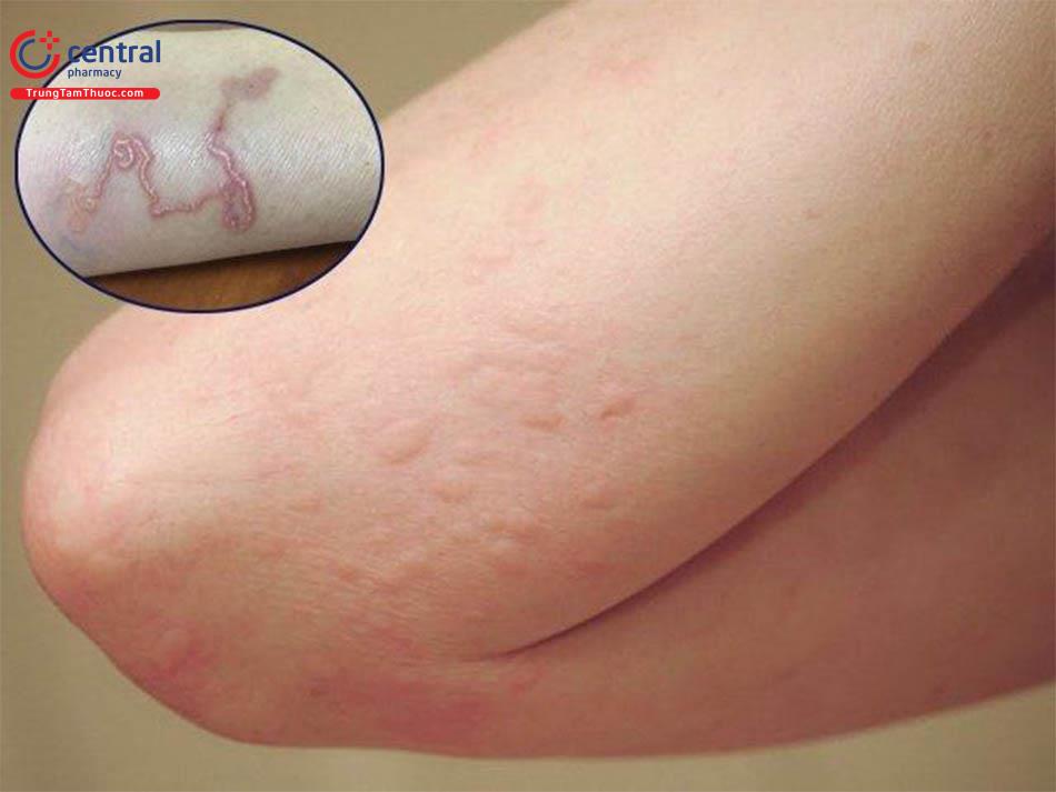 trẻ bị nhiễm sán lợn - Image 2