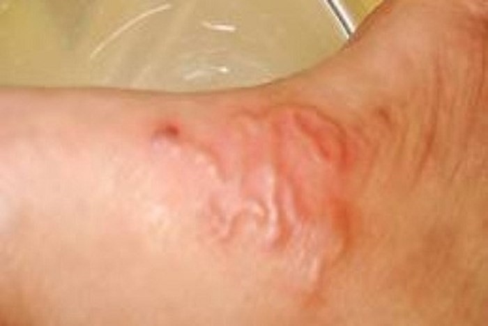 trẻ bị nhiễm sán lợn