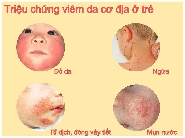 trẻ bị viêm da cơ địa - Image 4
