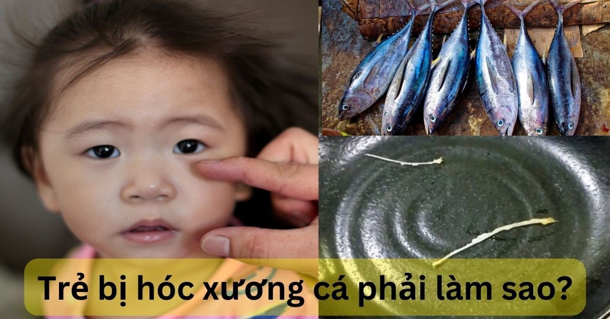 trẻ hóc xương cá làm thế nào - Image 2