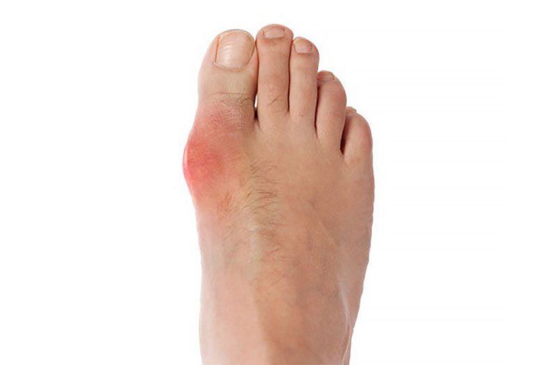 triệu chứng bệnh gout - Image 2