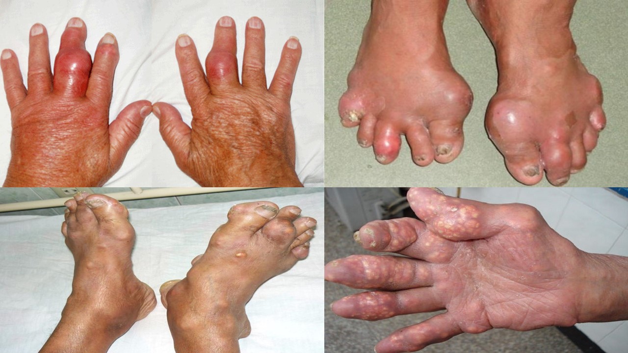 triệu chứng bệnh gout - Image 3