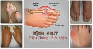 triệu chứng bệnh gout