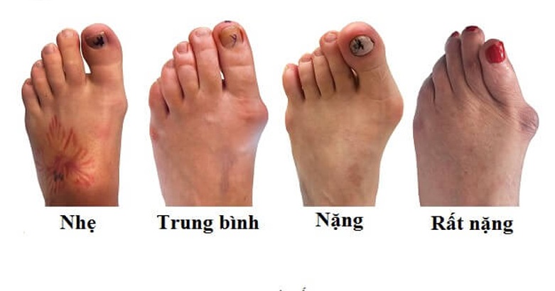 triệu chứng bệnh gout - Image 4