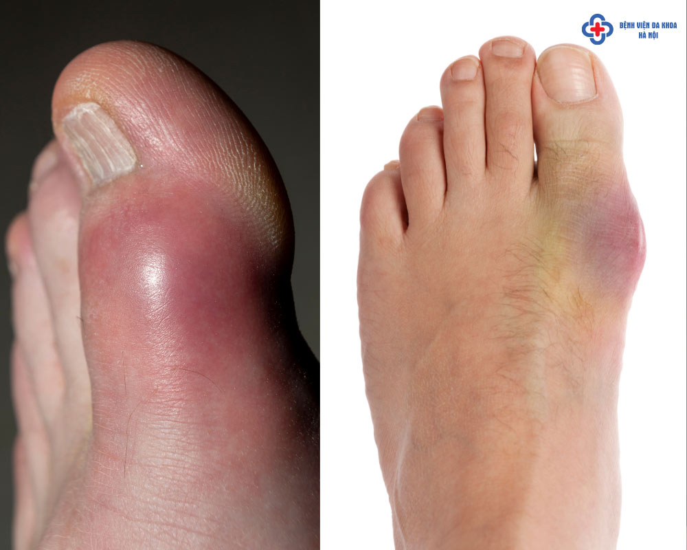 triệu chứng bệnh gout - Image 5