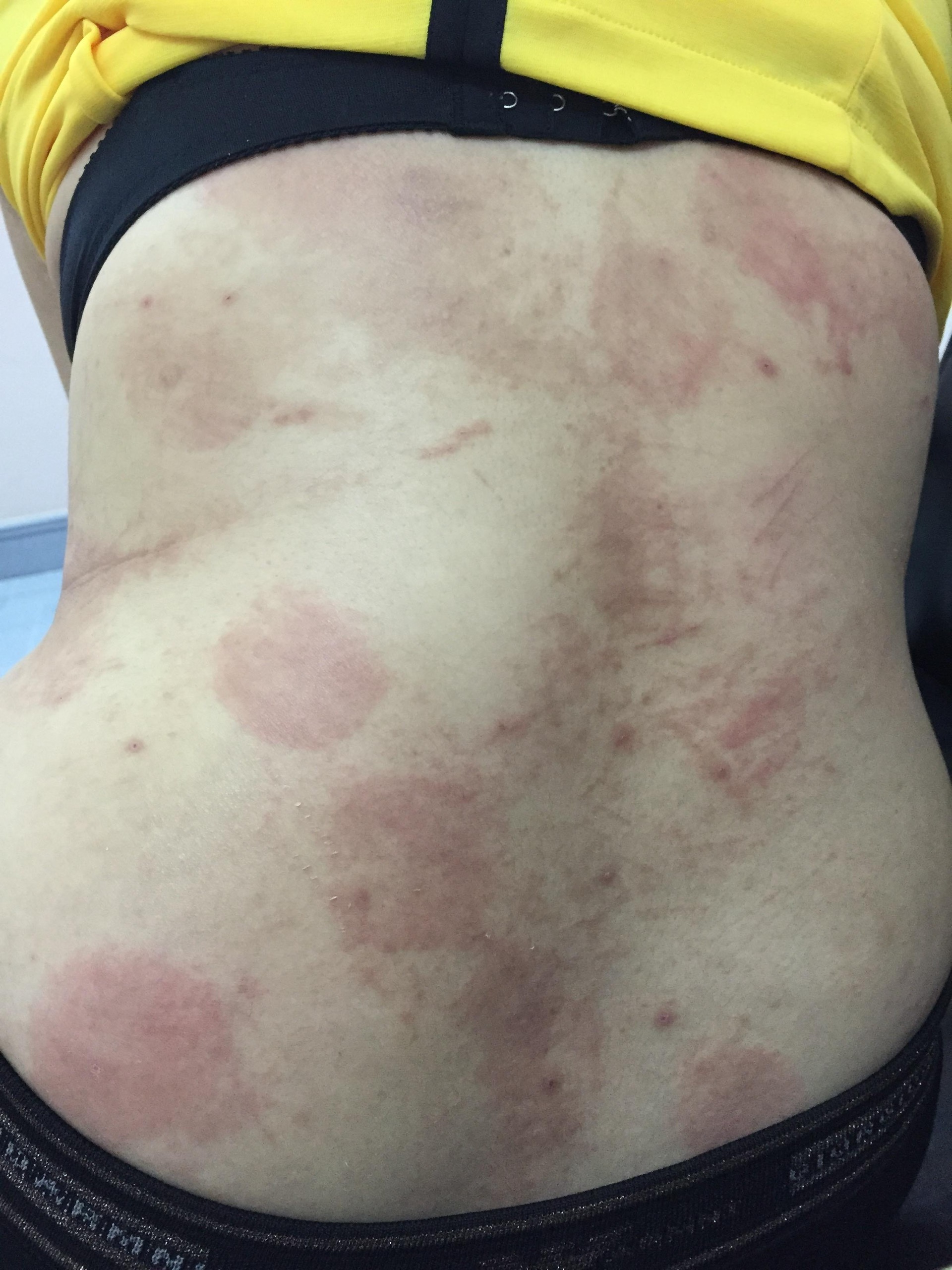 triệu chứng bị giun ở người lớn - Image 3