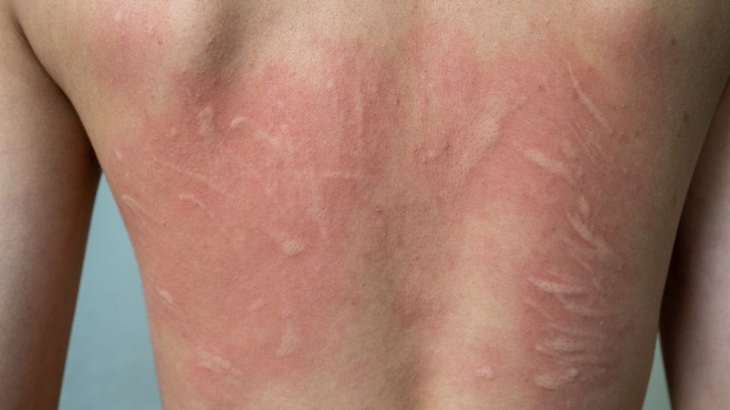 triệu chứng bị giun ở người lớn - Image 4