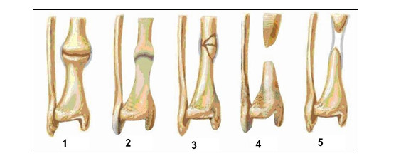triệu chứng chậm liền xương - Image 4