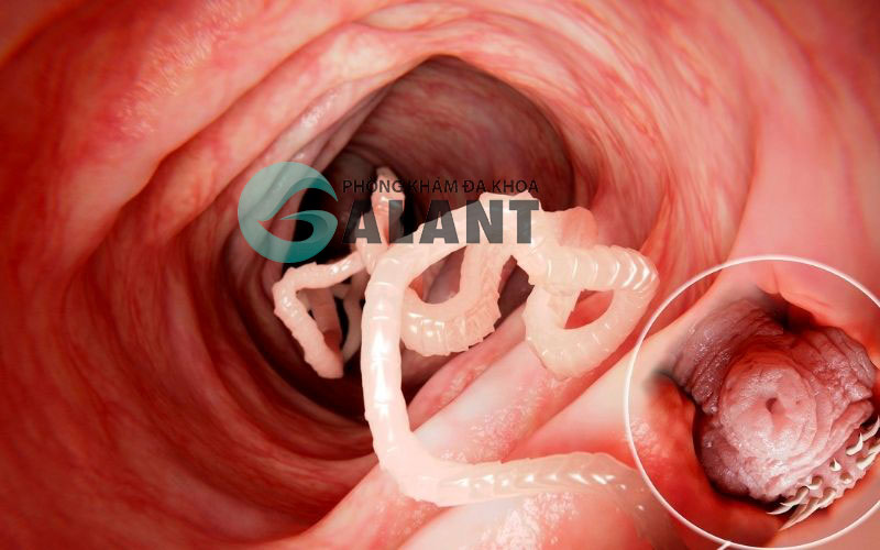 triệu chứng đau bụng giun ở người lớn - Image 3