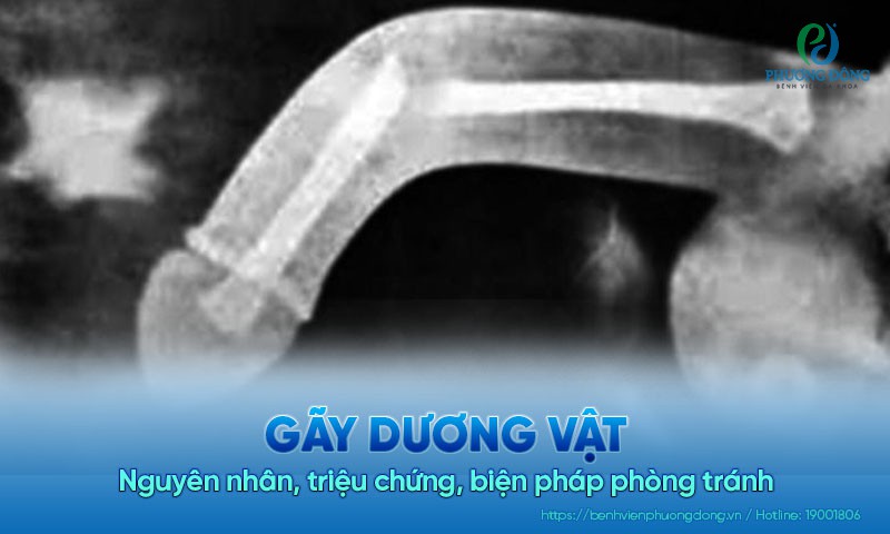 trieu chung gay duong vat - Image 2