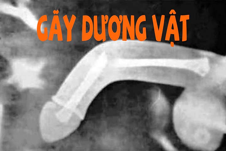 trieu chung gay duong vat - Image 3