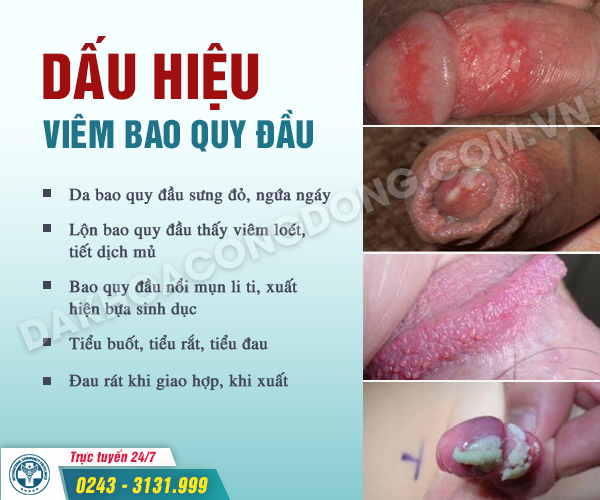 trieu chung gay duong vat - Image 4