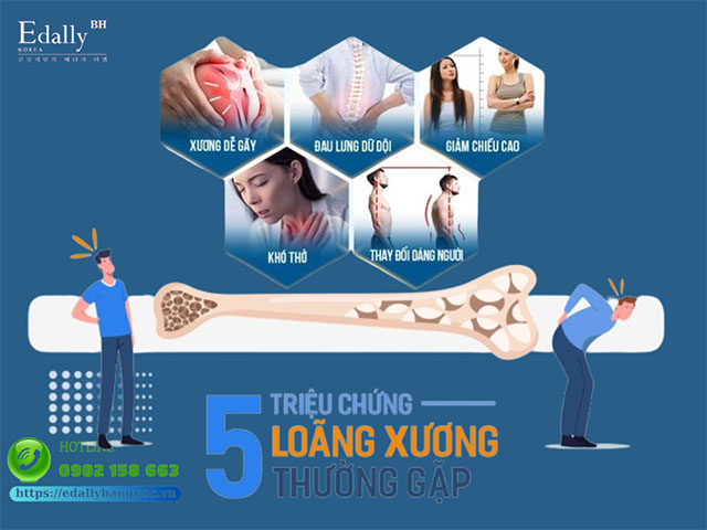 triệu chứng loãng xương - Image 2