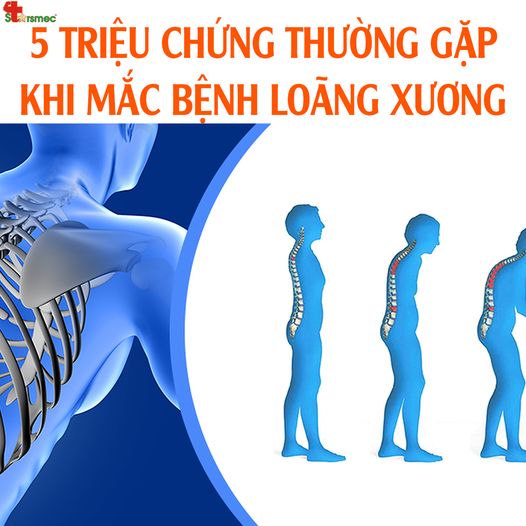 triệu chứng loãng xương - Image 3