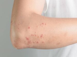 triệu chứng nhiễm giun sán
