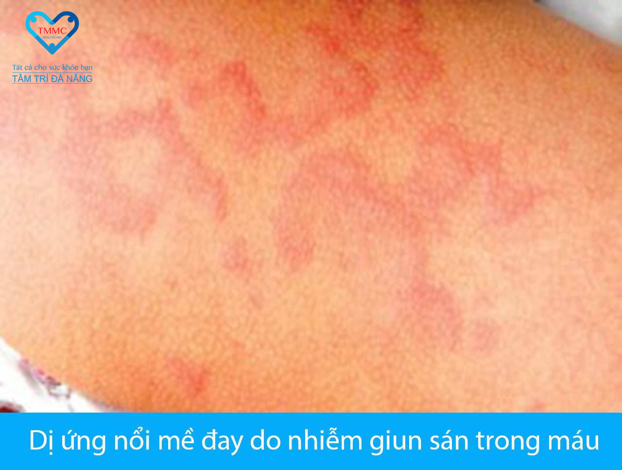 triệu chứng nhiễm giun sán - Image 5