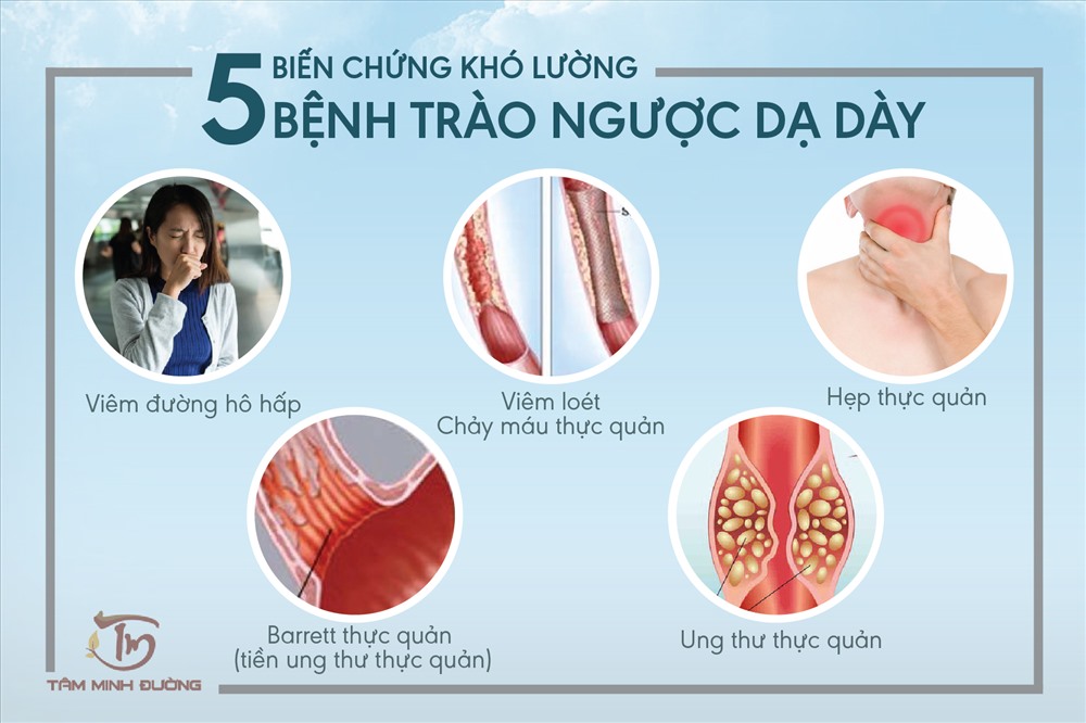 triệu chứng trào ngược dạ dày - Image 4