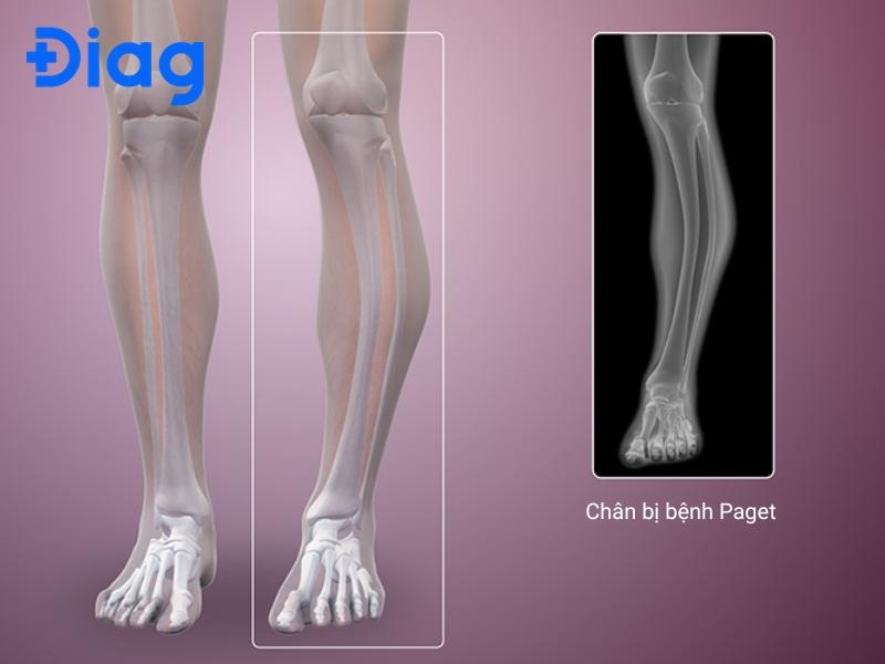 triệu chứng ung thư xương cẳng chân - Image 4