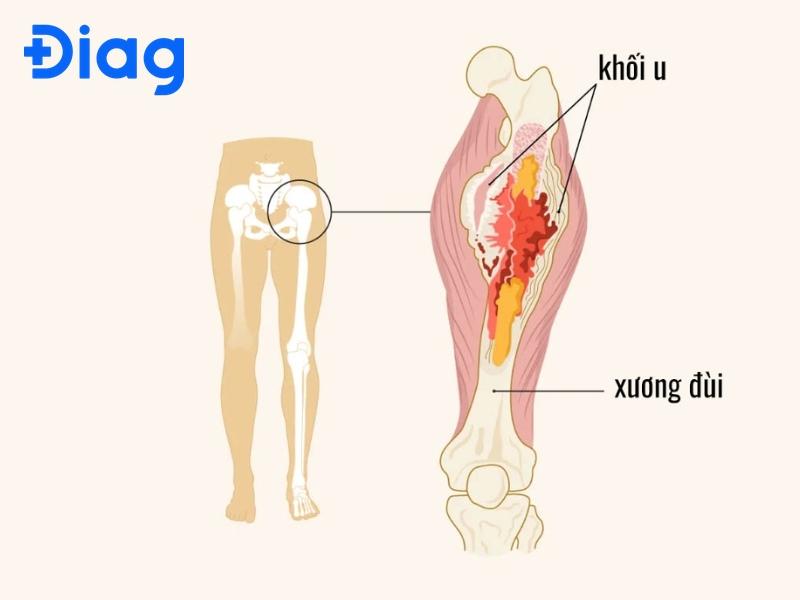 trieu chung ung thu xuong dui - Image 4