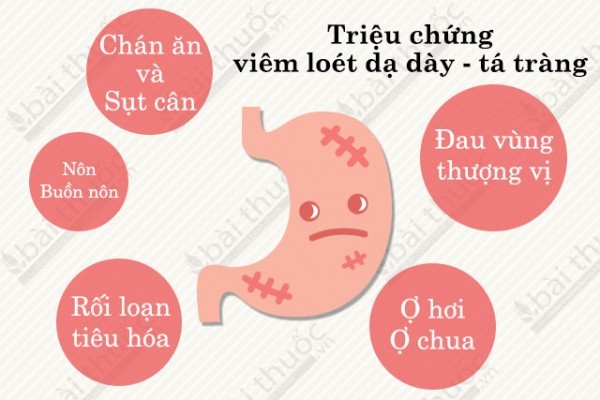 triệu chứng viêm loét dạ dày - Image 4