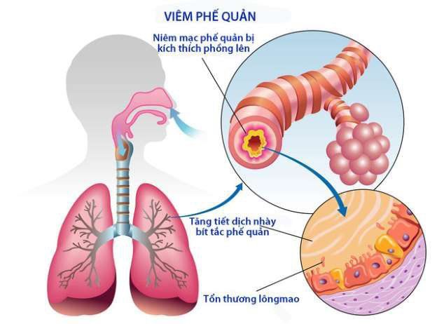 triệu chứng viêm phế quản - Image 3