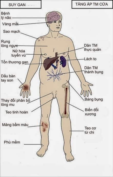 triệu chứng xơ gan - Image 3