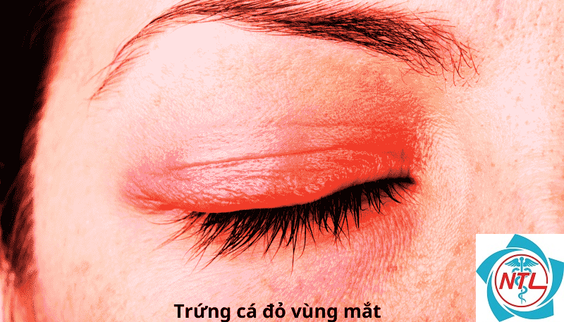 trứng cá đỏ ở mắt - Image 2