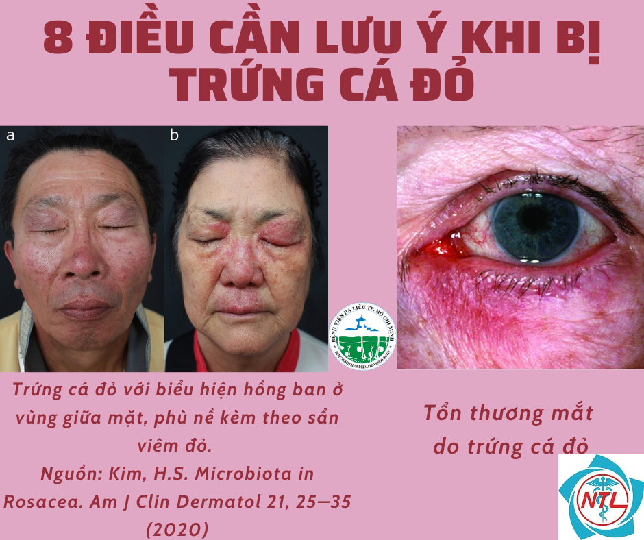 trứng cá đỏ ở mắt - Image 1