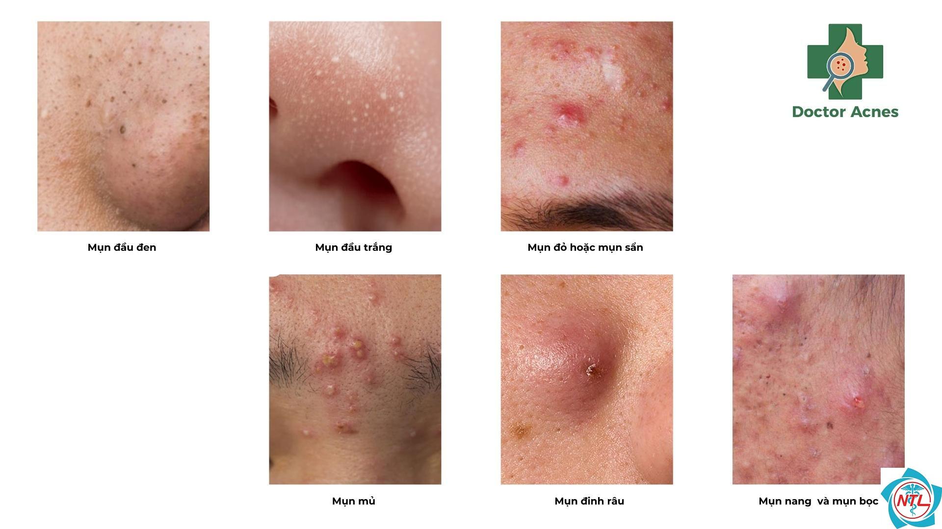 trứng cá đỏ ở nam giới - Image 3
