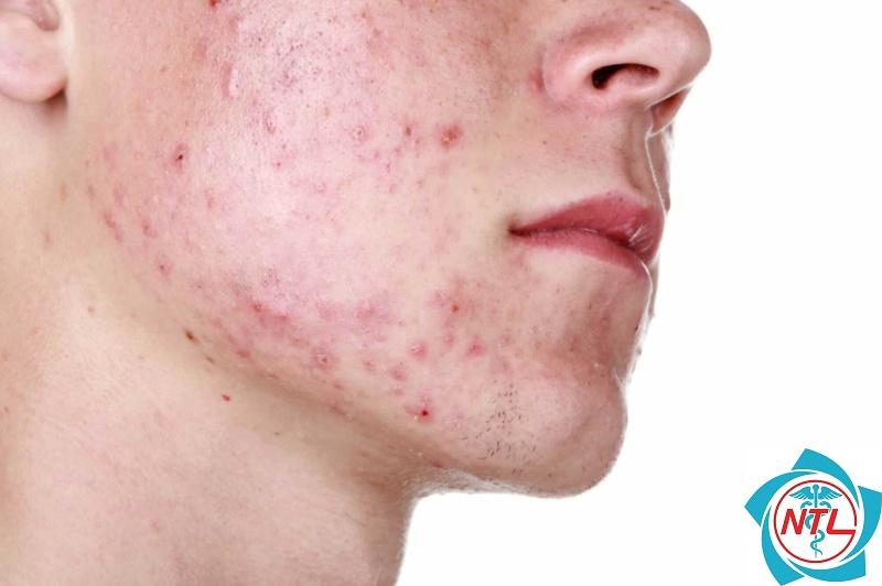 trứng cá đỏ ở nam giới