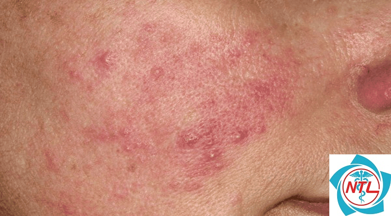 trứng cá đỏ ở người lớn - Image 3