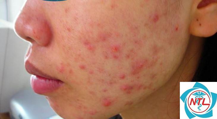 trứng cá đỏ ở người lớn