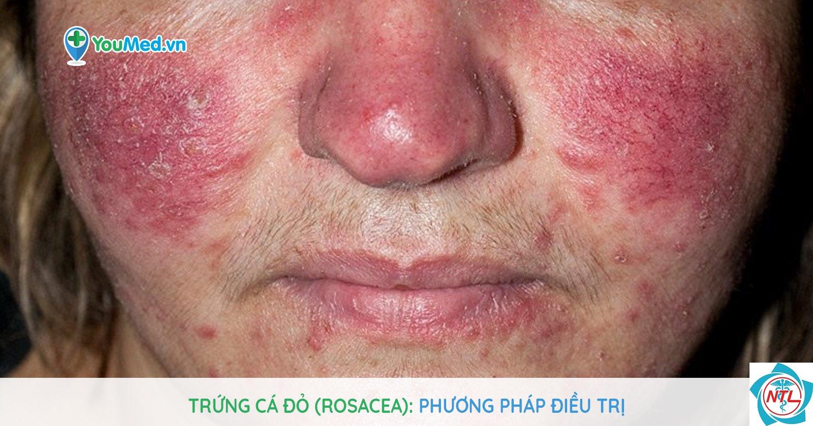 trứng cá đỏ ở phụ nữ - Image 3