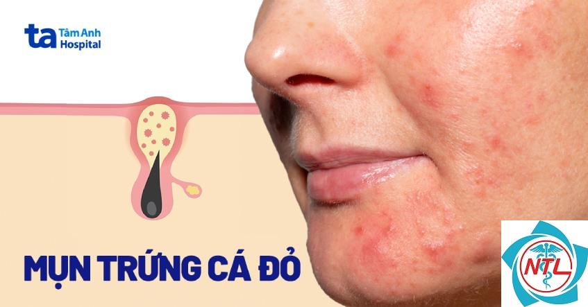 trứng cá đỏ vùng má