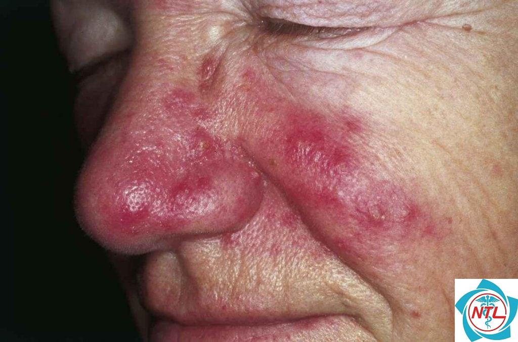 trứng cá đỏ vùng mũi