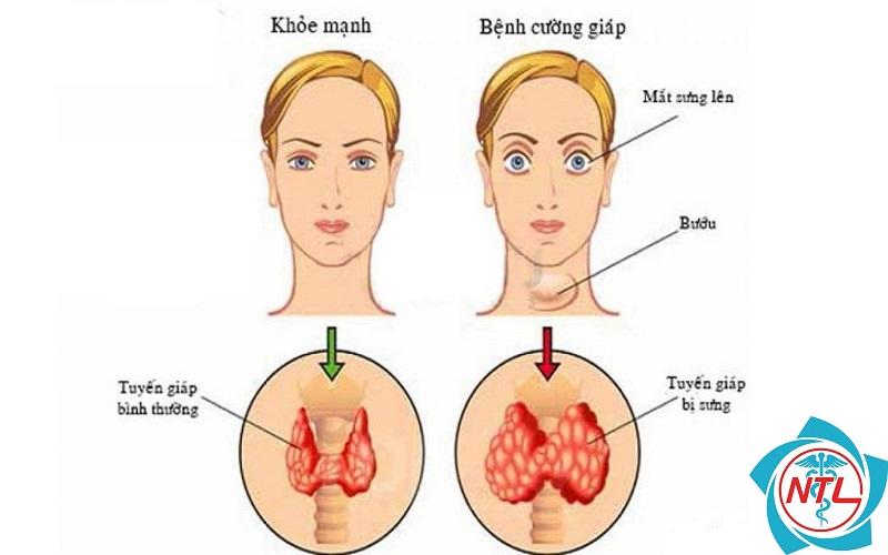 tuyến giáp trạng - Image 4