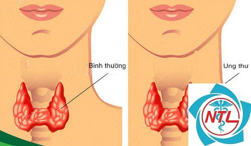tuyến giáp trạng