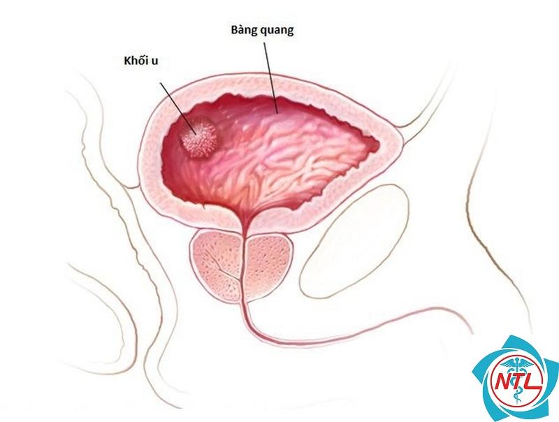 u bàng quang lành tính